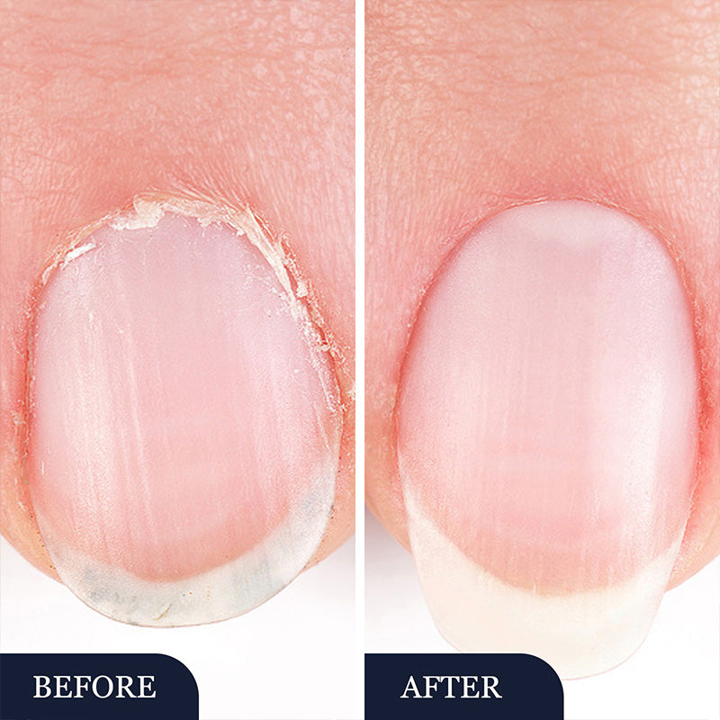 🔥Lábujjköröm gomba kezelő toll (sérült körmökre)